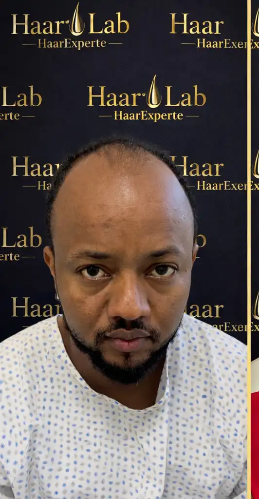 Haartransplantation Mannheim vorher