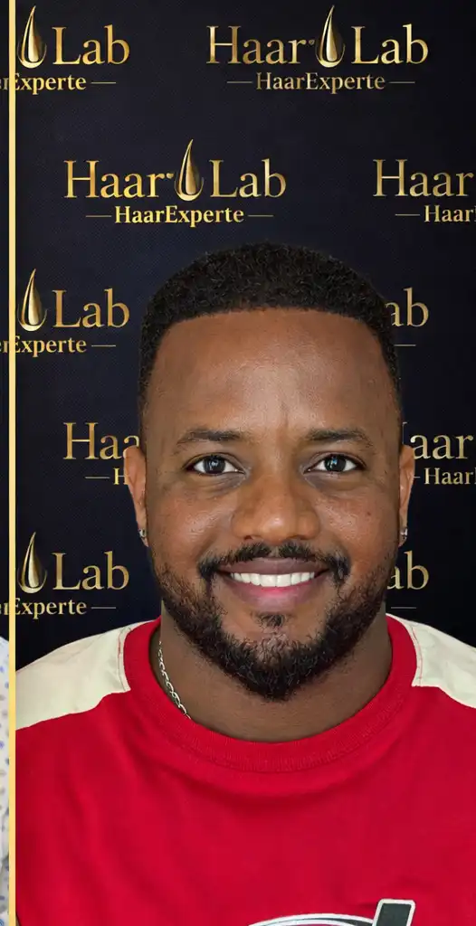 Haartransplantation Mannheim nachher