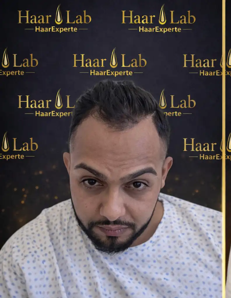 Haartransplantation Mannheim vorher