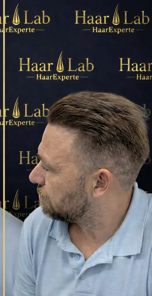 Haartransplantation Mannheim nachher